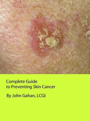 cover image of Complete Guide to Preventing Skin Cancer